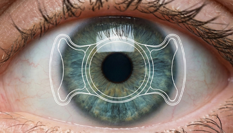 ICL Surgery