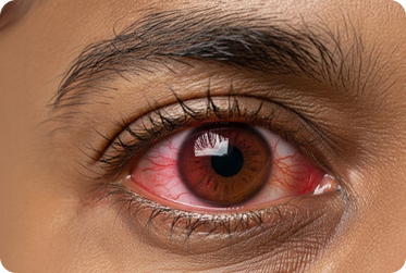 Dry Eye Treatment