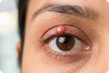 Eyelid Surgery