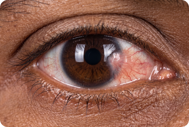 Pterygium Surgery